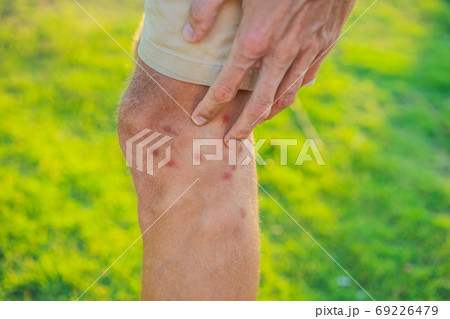 Legs with many red spot and scar from insect bites. Mosquitos allergy. Sand fly bites 69226479