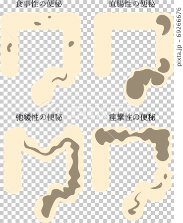 便秘の種類イラスト 69266676