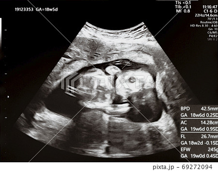 妊娠して17週目の胎児のエコー写真の写真素材