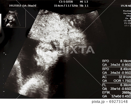 妊娠して36週目の胎児のエコー写真の写真素材