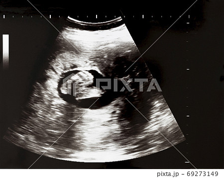 胎児の足の裏のエコー写真の写真素材