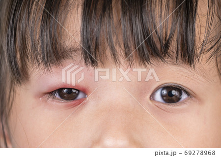 Asian girl with red pink eye inflammation blepharitis from allergy Asian girl with red pink eye inflammation blepharitis from allergy 69278968
