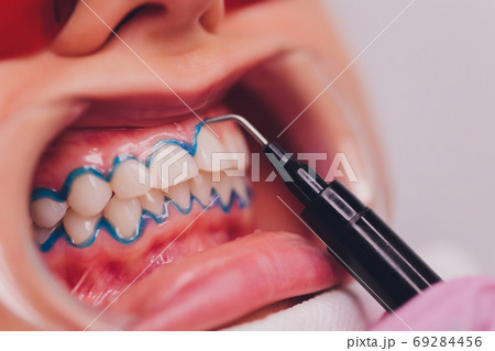 Close-up portrait of a female patient visiting dentist for teeth whitening in clinic,Teeth whitening procedure. Close-up portrait of a female patient visiting dentist for teeth whitening in clinic,Teeth whitening procedure. 69284456