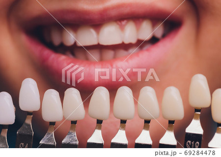 The dentist comparing patient's teeth shade with samples for bleaching treatment. 69284478
