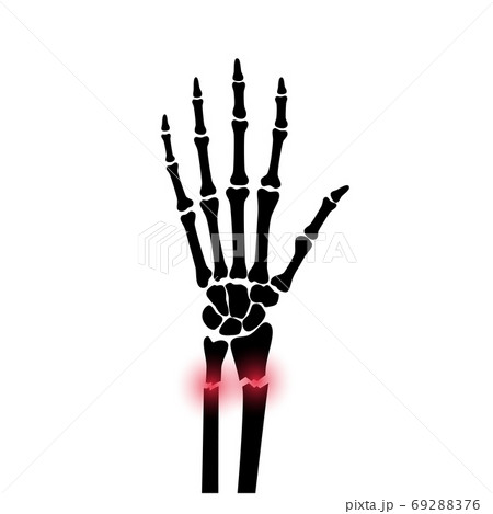 Fracture x ray concept Fracture x ray concept 69288376