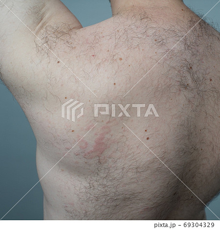 Allergy reaction is red spots on the body of a young man. 69304329