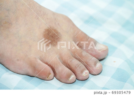 Dermatitis foot have a dark, circular appearance. 69305479