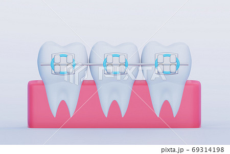 Three Teeth with Metal Braces in the gum. Care, Orthodontics and Dentistry symbols, 3D render 69314198