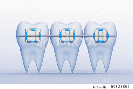 Three Teeth with Metal Braces. Care, Orthodontics and Dentistry symbols, 3D render Three Teeth with Metal Braces. Care, Orthodontics and Dentistry symbols, 3D render 69328862
