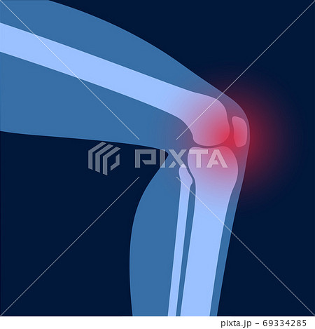 Arthritis in knee joint Arthritis in knee joint 69334285