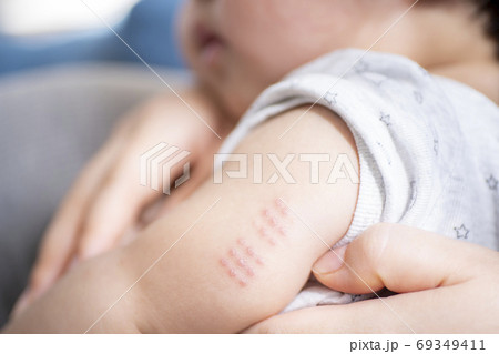 7ヶ月男児のbcg跡の写真素材