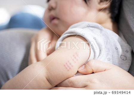 7ヶ月男児のbcg跡の写真素材