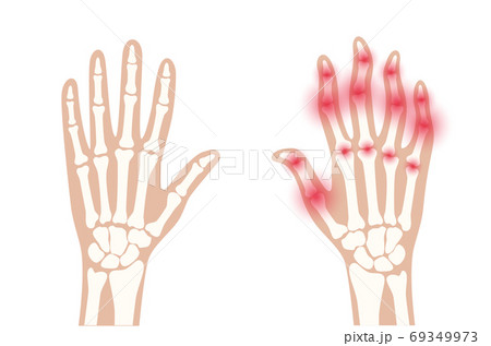 Arthrits x ray 69349973