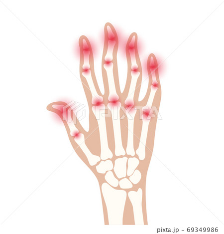 Arthrits x ray 69349986