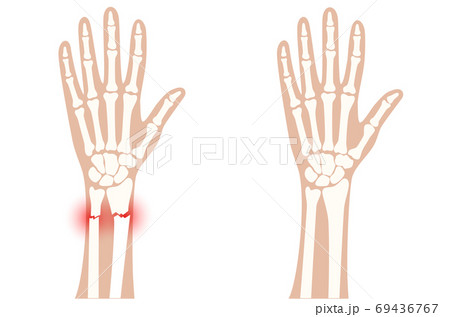 Fracture x ray concept 69436767