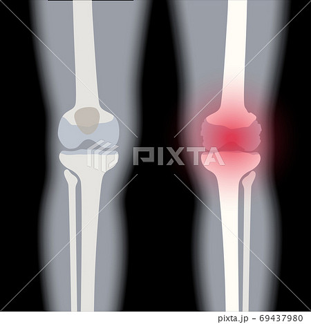 Arthritis in knee joint 69437980