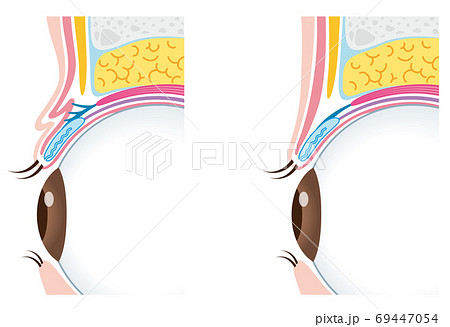 二重瞼と一重瞼の構造 比較 まぶた 断面図 二重瞼と一重瞼の構造 比較 まぶた 断面図 69447054