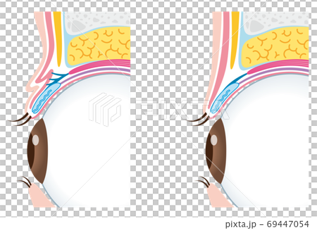 二重瞼と一重瞼の構造 比較 まぶた 断面図 二重瞼と一重瞼の構造 比較 まぶた 断面図 69447054