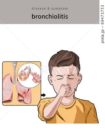 気管支炎 咳 子供 69473753