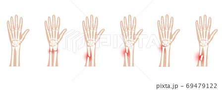 Fracture x ray concept Fracture x ray concept 69479122