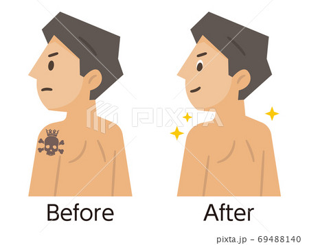 刺青・タトゥー除去のビフォーアフター 69488140