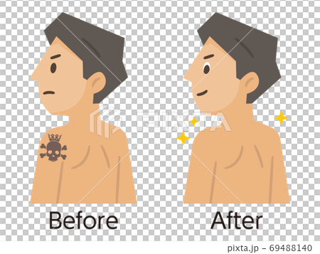 刺青・タトゥー除去のビフォーアフター 69488140