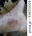 Very  painful  skin  disease  on left  side  of  human' leg . 69650009