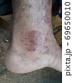 Very  painful  skin  disease  on left  side  of  human' leg . 69650010