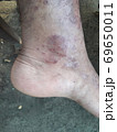 Very  painful  skin  disease  on left  side  of  human' leg . 69650011