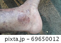 Very  painful  skin  disease  on left  side  of  human' leg . 69650012