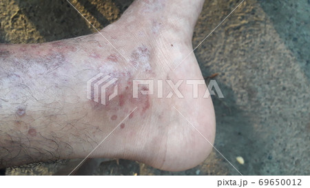 Very painful skin disease on left side of human' leg . Very painful skin disease on left side of human' leg . 69650012