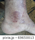 Very  painful  skin  disease  on left  side  of  human' leg . 69650013