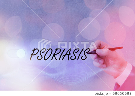 Text sign showing Psoriasis. Conceptual photo Text sign showing Psoriasis. Conceptual photo 69650693