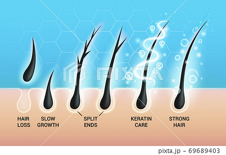 Different hair problems and deep salon treatment vector illustrations set, macro view of balding scalp skin and follicles 69689403