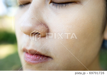 Allergic young woman have eczema dry nose on winter season,female people peeling skin with seborrheic dermatitis,atopic symptom on her nose,flaky skin on the face or allergic reaction on facial skin 69701726