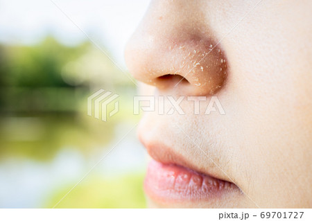 Allergic young woman have eczema dry nose on winter season,female people peeling skin with seborrheic dermatitis,atopic dermatitis symptom on her nose,flaky skin on the face or allergic reaction on fa 69701727