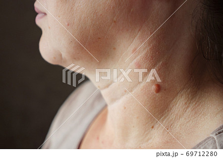 Close-up of a mole on a woman's neck 69712280