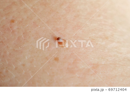 Close-up of a small mole with a growth Close-up of a small mole with a growth 69712404