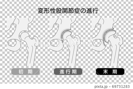 髖骨關節炎病情進展單調 69731283