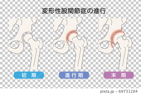 Illustration of the progression of coxarthrosis 69731284