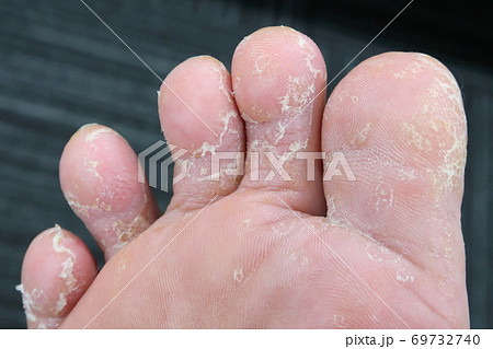 手足の肌荒れ 手足の肌荒れ 69732740