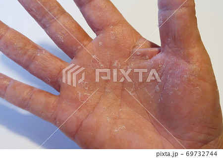 手足の肌荒れ 69732744