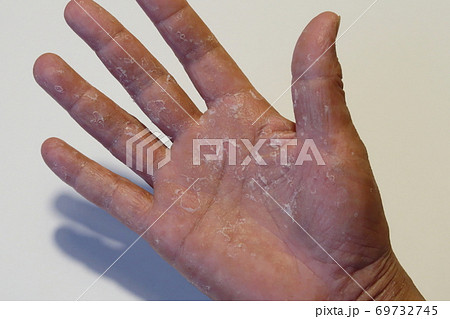 手足の肌荒れ 69732745