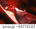 Artheriosclerosis close up 69770183