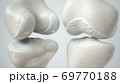 Knee osteoarthritis and healthy knee 69770188