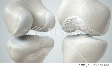 Knee osteoarthritis and healthy knee 69770188