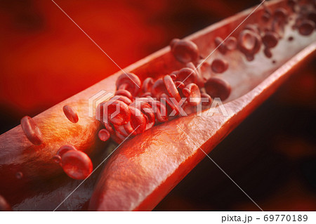 Artheriosclerosis close up 69770189