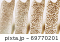 Osteoporosis course in 4 stages 69770201