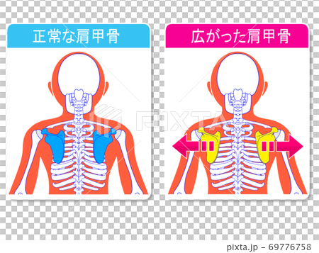 正常な肩甲骨と広がった肩甲骨のイラスト素材 正常な肩甲骨と広がった肩甲骨のイラスト素材