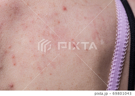 woman with skin problem acne on back 69801043